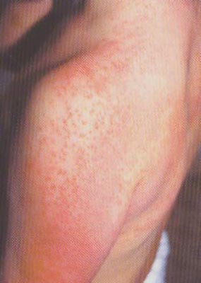 APEC syndrom