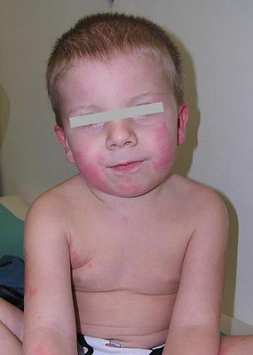 Megalerythema infectiosum