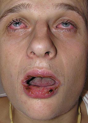 Stevensv-Johnsonv syndrom